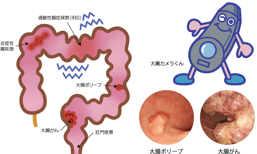 大腸内視鏡検査中に何が起こるのですか?